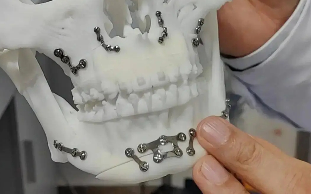 川大聯合研發國內首個3D打印頜面接骨板