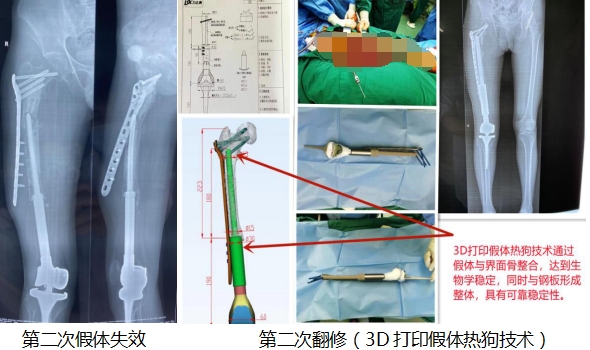 贵医附院成功实施高难度3D打印肿瘤假体置换手术